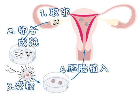 关于有偿同志借卵怎么选